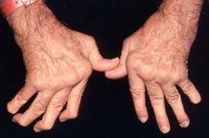Ревматоиден артрит