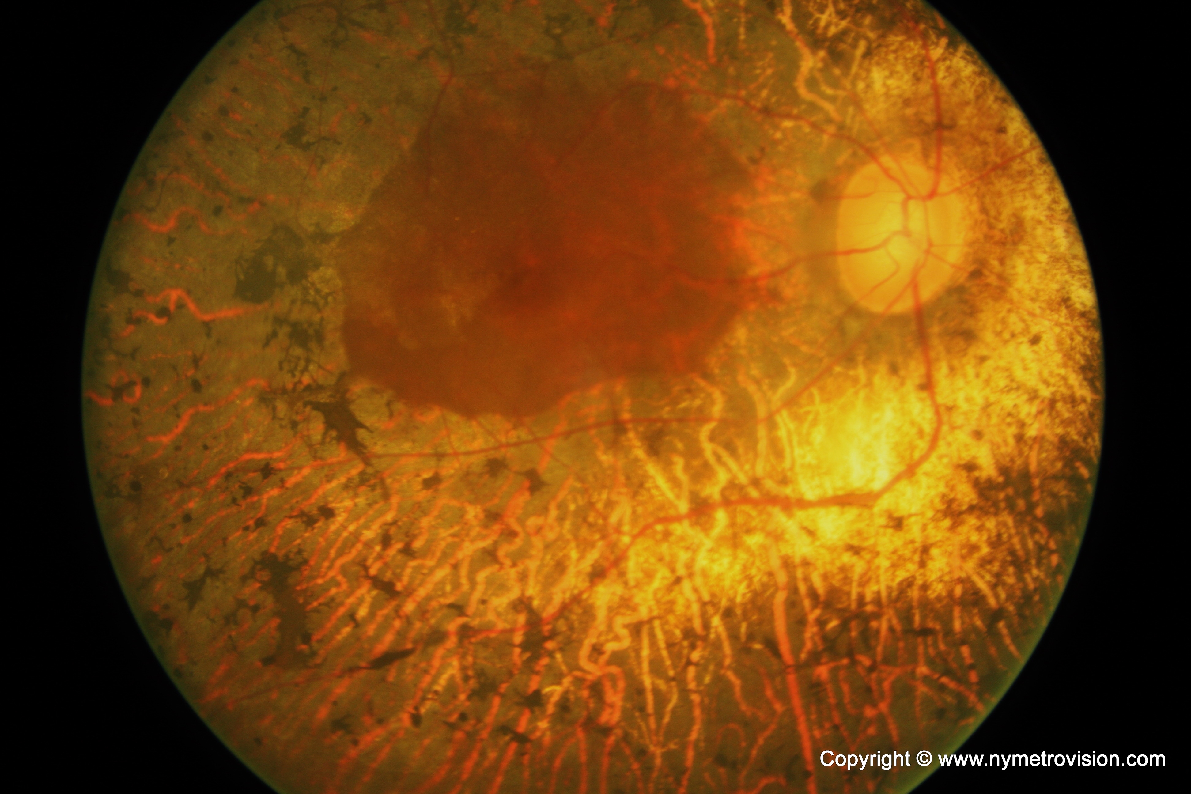 Пигментозен ретинит