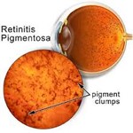 retiinis pigmentosa